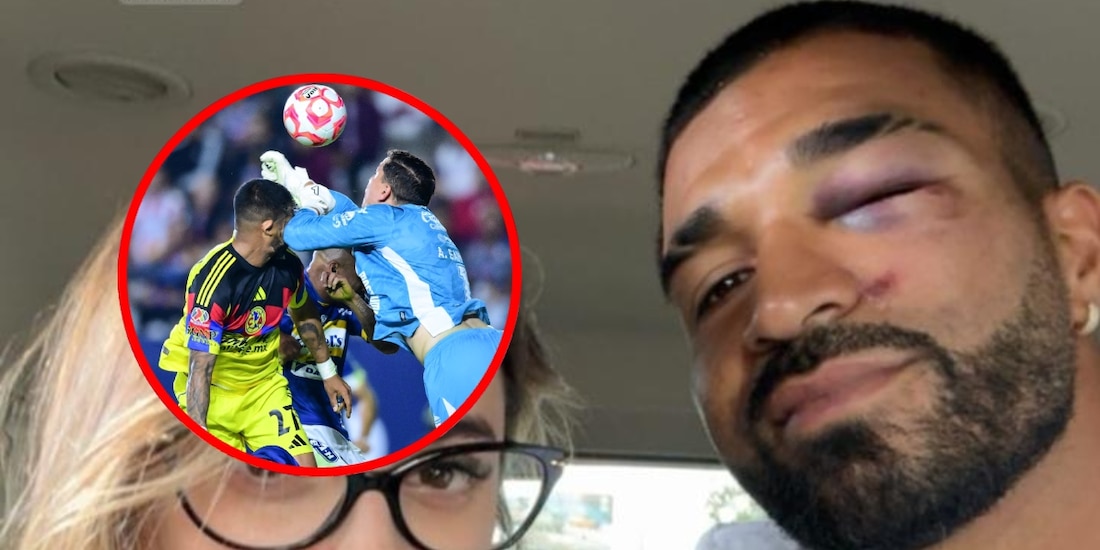 Así le quedó el rostro a Rodrigo Aguirre tras el fuerte golpe ante San Luis