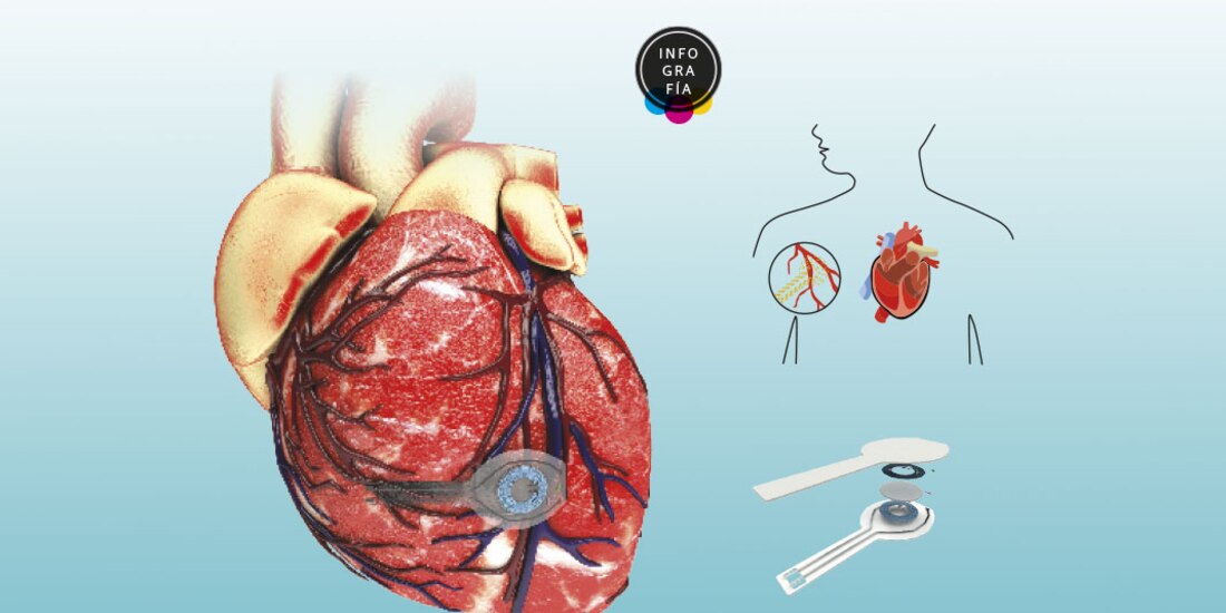 Crean marcapasos biodegradable que se disuelve una vez que el corazón late correctamente<br>sos